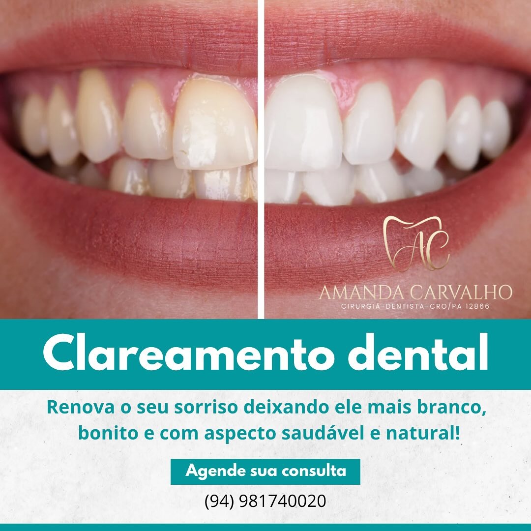 Clareamento dental antes e depois