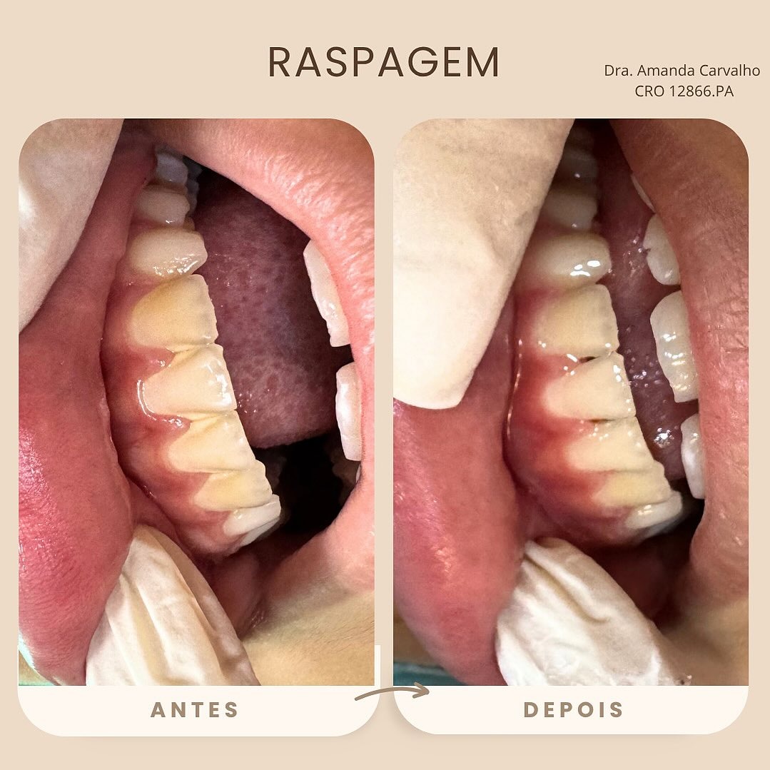 Procedimento de limpeza antes e depois na clínica em Tucuruí